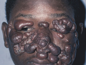 a leishmaniose Cutâneo-mucosa