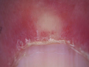 Cutaneous lupus erythematosus