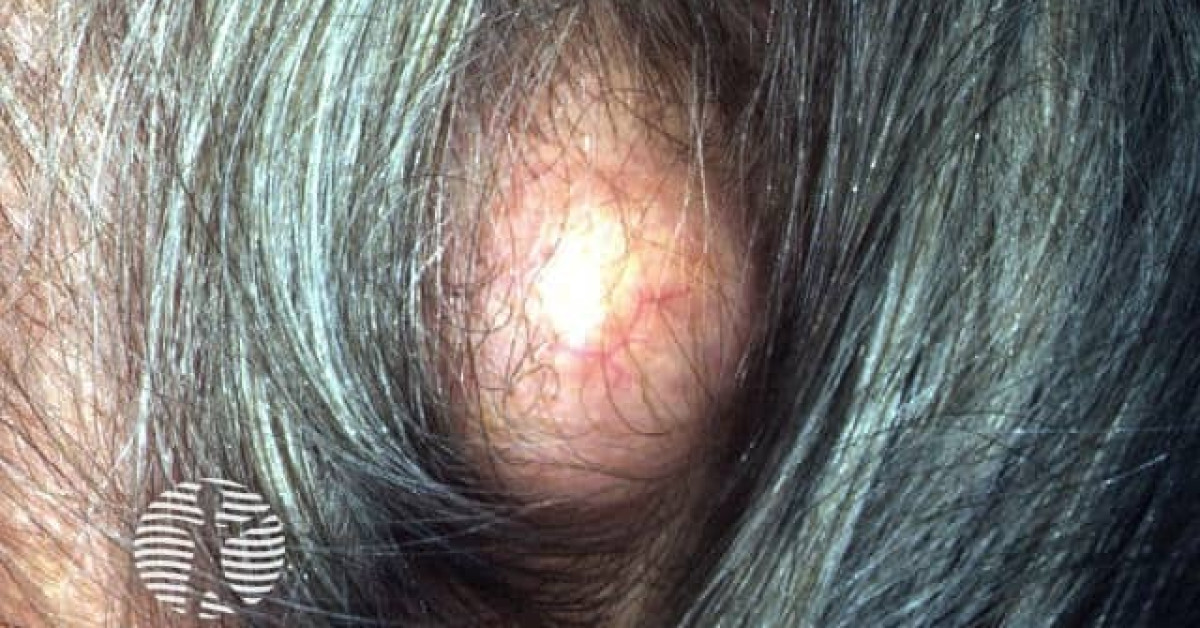 cyst-image