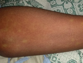 dengue fever symptoms rash