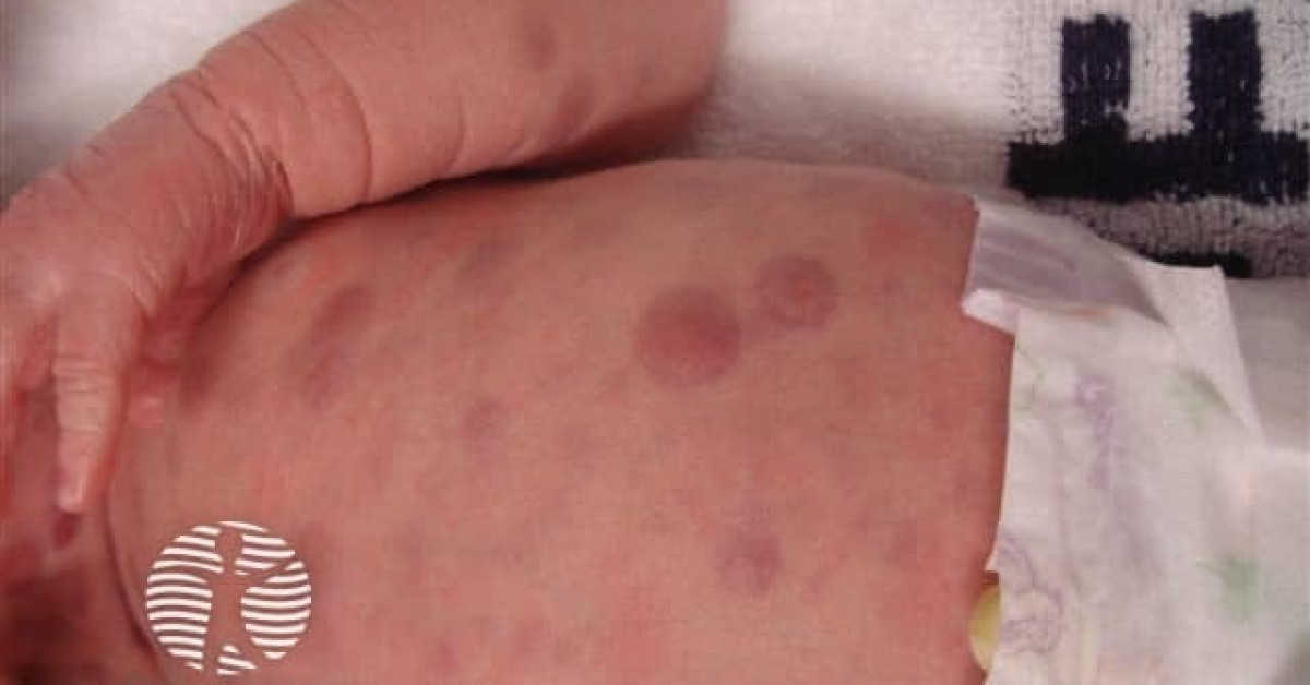 Blueberry muffin syndrome image