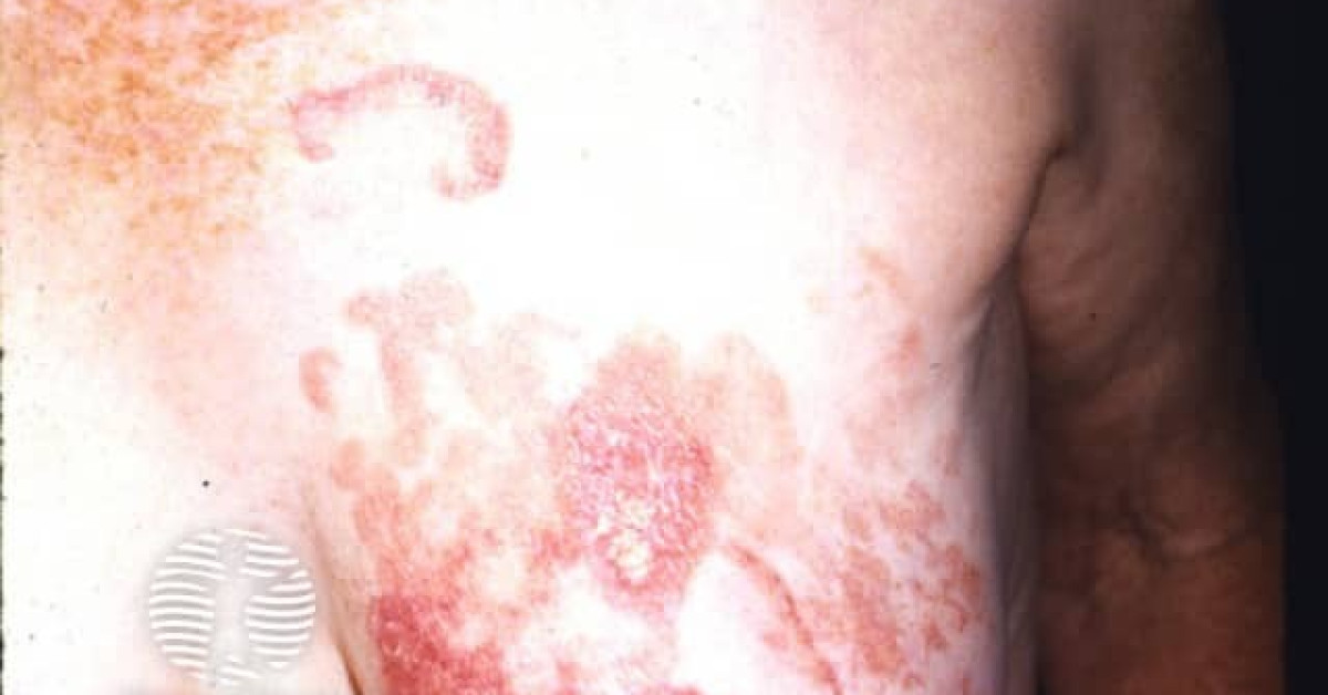 Mycosis fungoides image