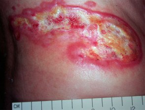 Mycosis fungoides, ulcerated