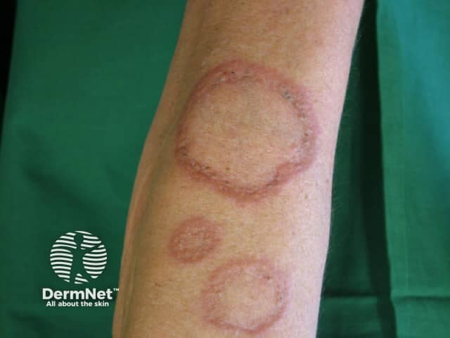 Granuloma Annulare Elbow Palisaded Granulomatous Dermatitis Associated