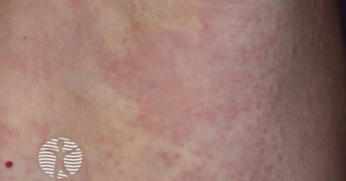 Granuloma annulare image