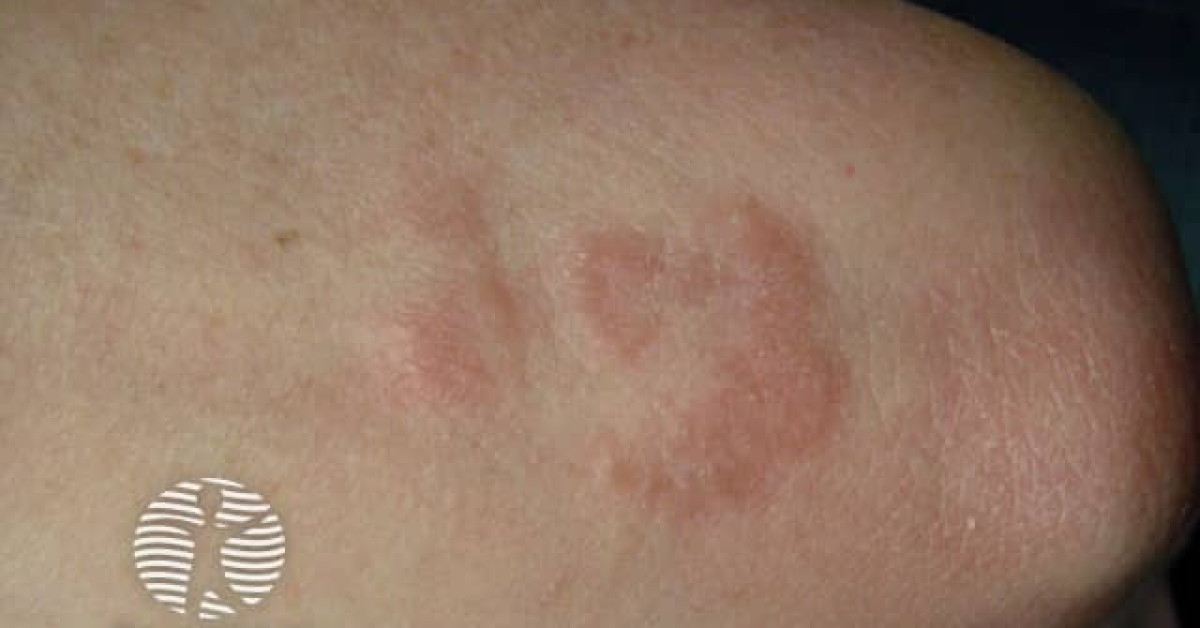 Granuloma Annulare Image