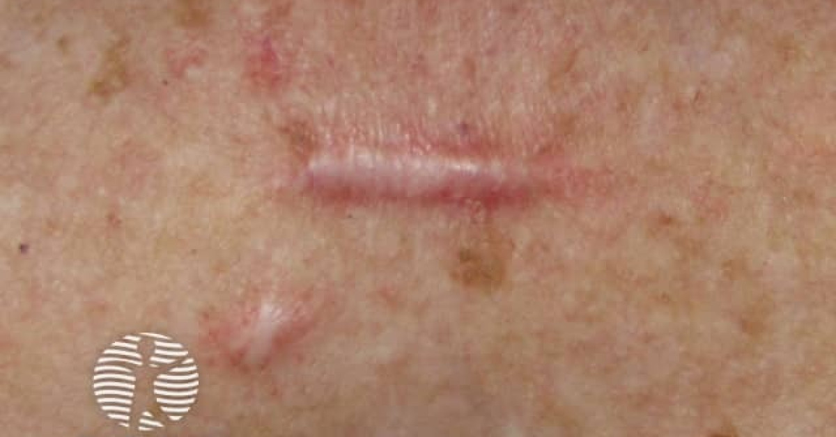 dermnet-hypertrophic-scar-image