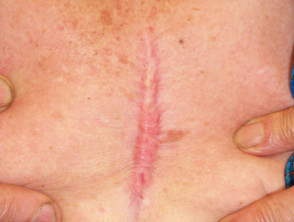 Hypertrophic scar