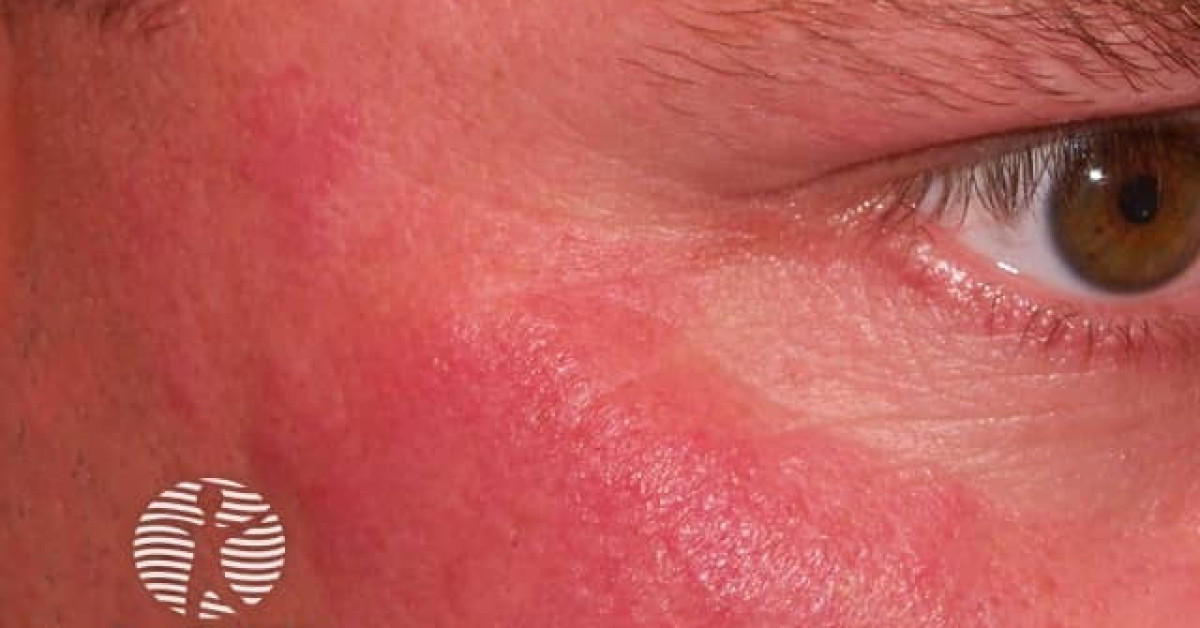 lymphocytic infiltrate of jessner