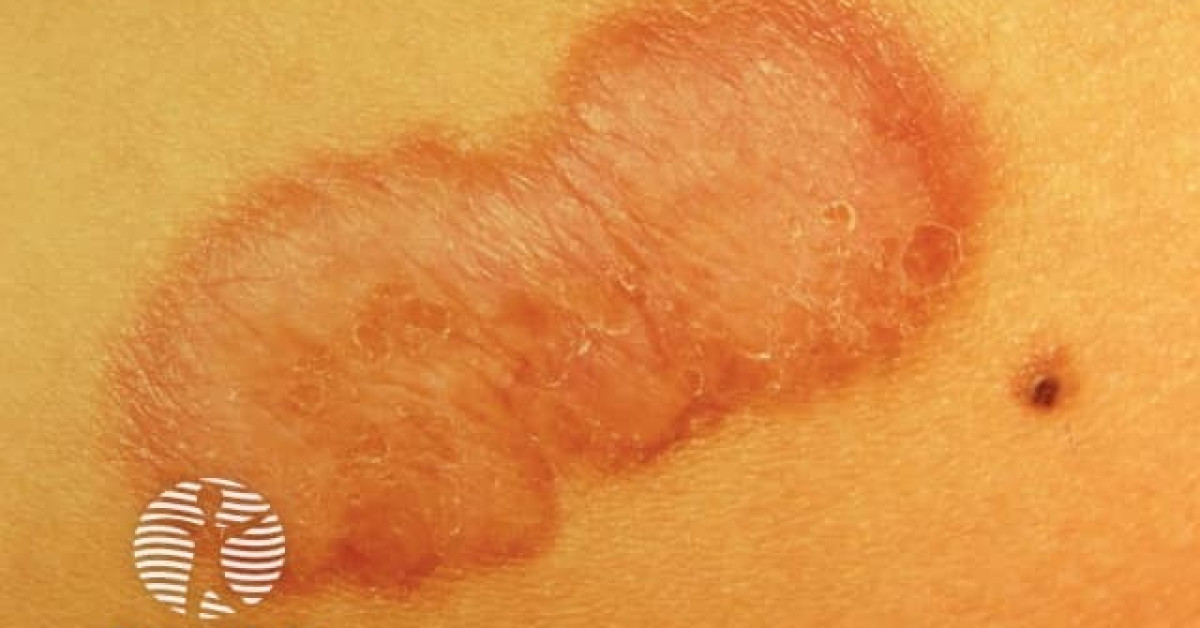Keloid scar image