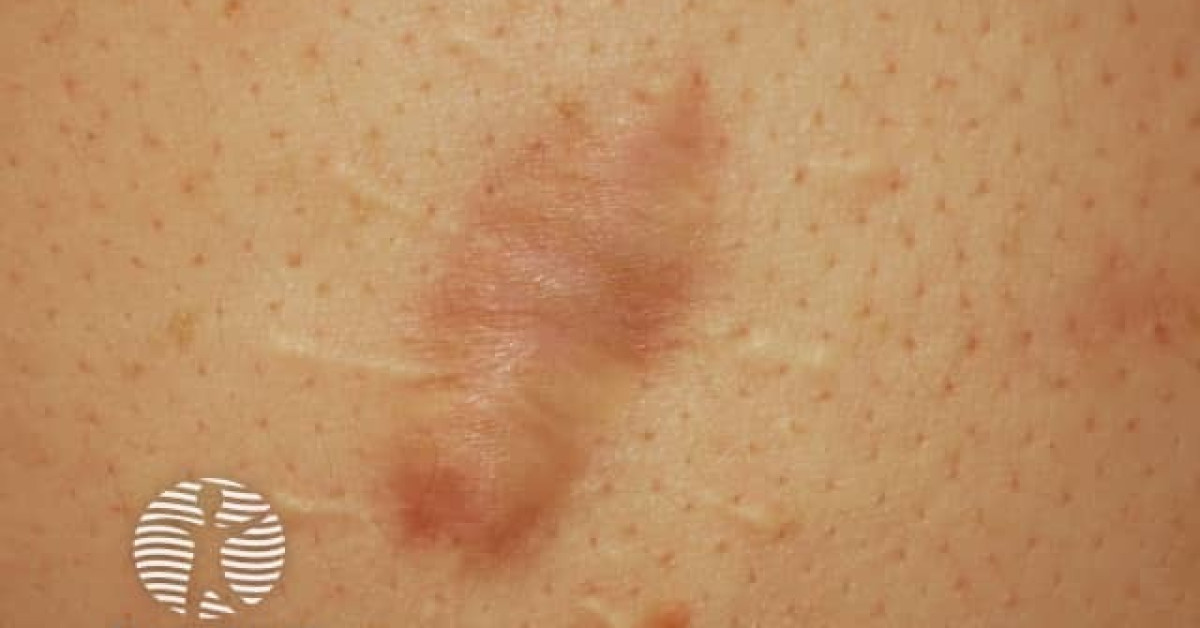 Keloid scar image