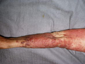 myelodysplastic syndrome skin