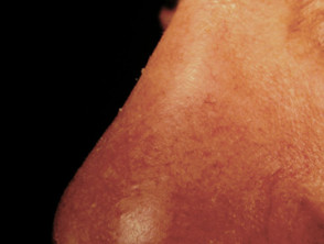 Lupus pernio. Cutaneous sarcoidosis