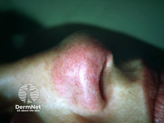 Lupus pernio. Cutaneous sarcoidosis