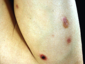 Lymphomatoid papulosis
