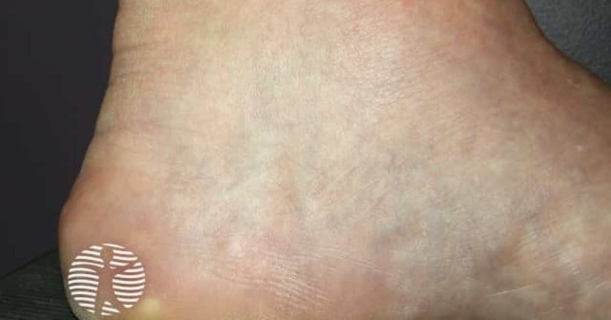 DermNet® - Piezogenic papules image