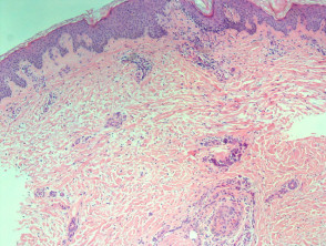 Pretibial myxoedema in Graves disease