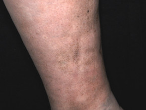 Pretibial myxoedema in Graves disease