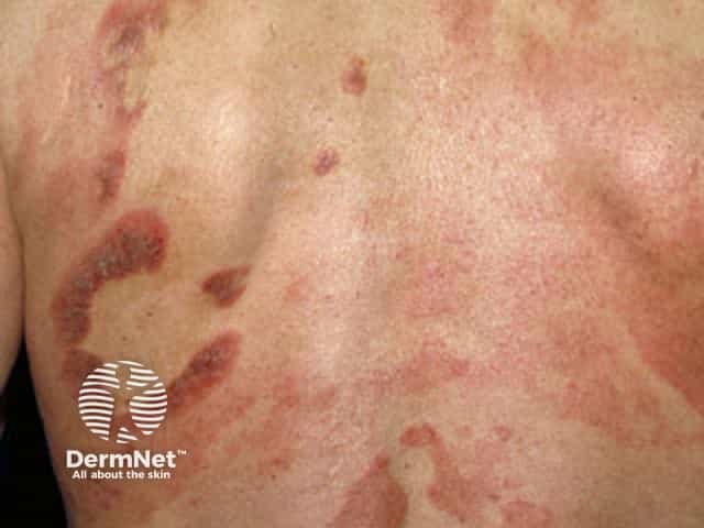 Patches and plaques of mycosis fungoides