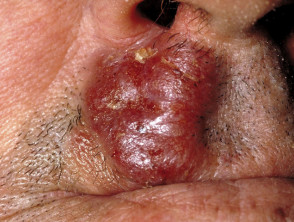 Mycosis fungoides
