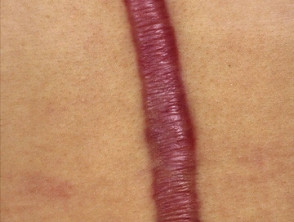 Why did my scar turn purple