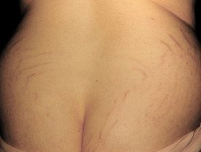 Stretch Marks On Breasts Teenagers