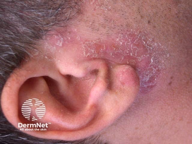 Airborne dermatitis due to epoxy allergy