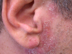 Airborne dermatitis due to epoxy allergy