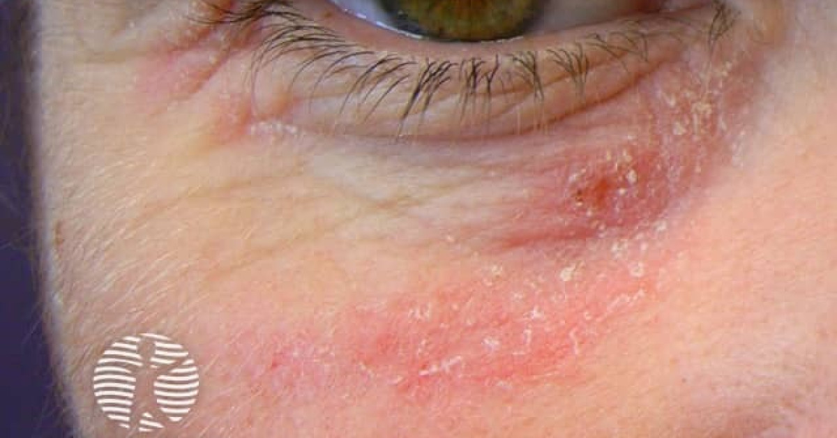Contact allergic dermatitis under the eye image