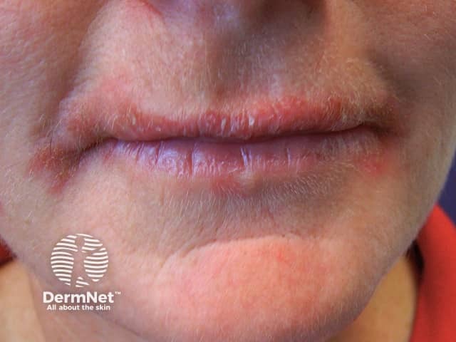 Contact allergic dermatitis on the lips