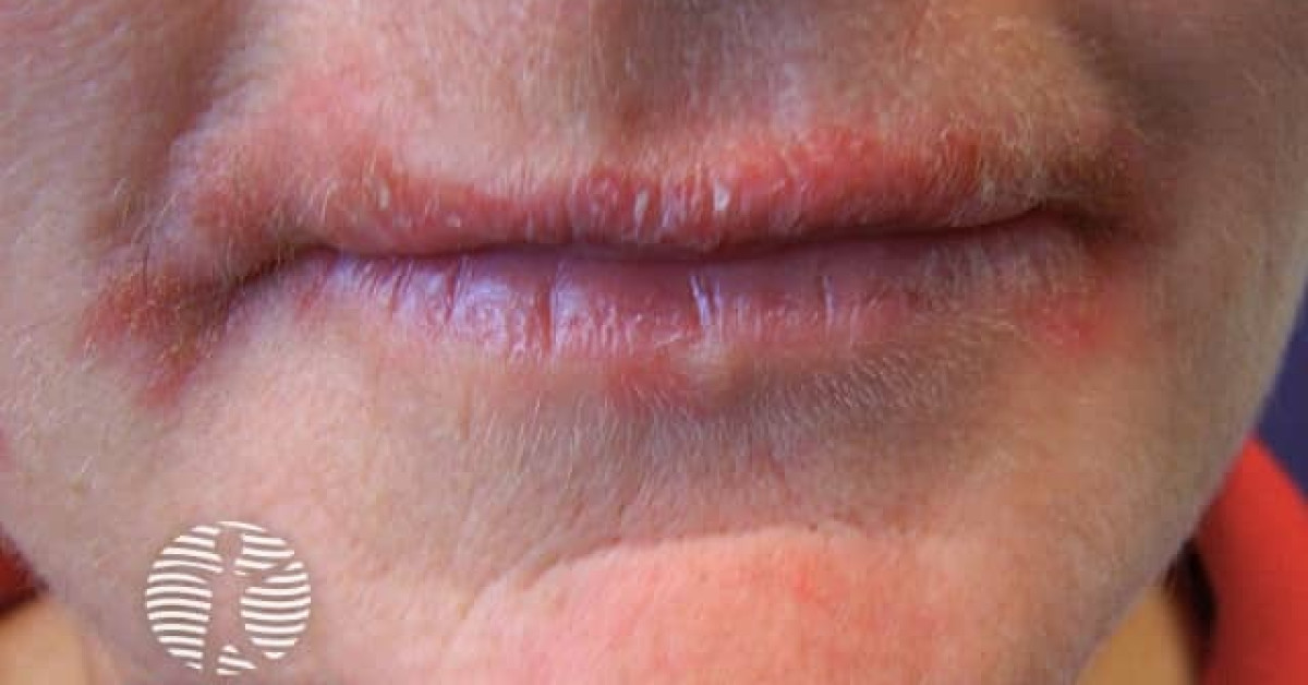 Contact allergic dermatitis on the lips image