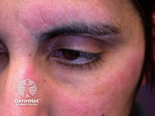 Contact allergic dermatitis around the eye