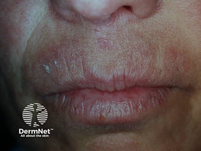 Contact allergic dermatitis around the lips