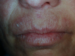 Contact allergic dermatitis of the face images | DermNet