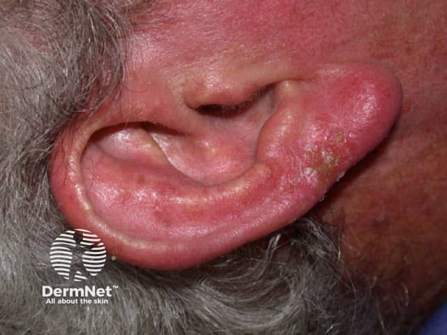 Contact allergic dermatitis on the ear