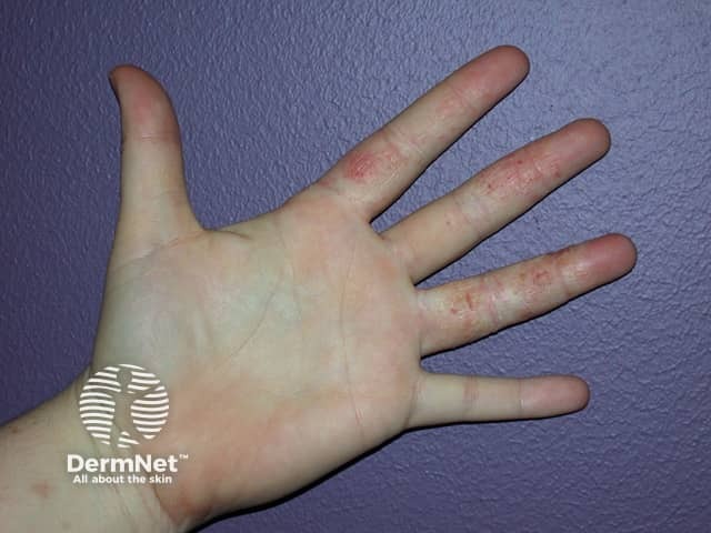 Contact allergic dermatitis of the hands