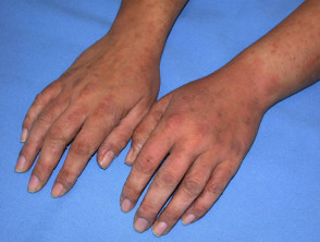 contact dermatitis wrist