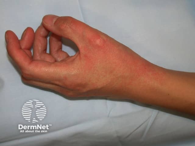 Contact allergic dermatitis of the hands