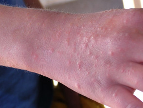 eczema on arms