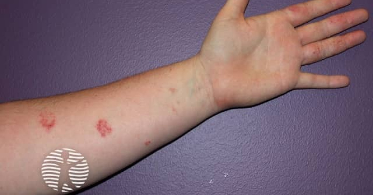 Contact allergic dermatitis of the arms and legs image