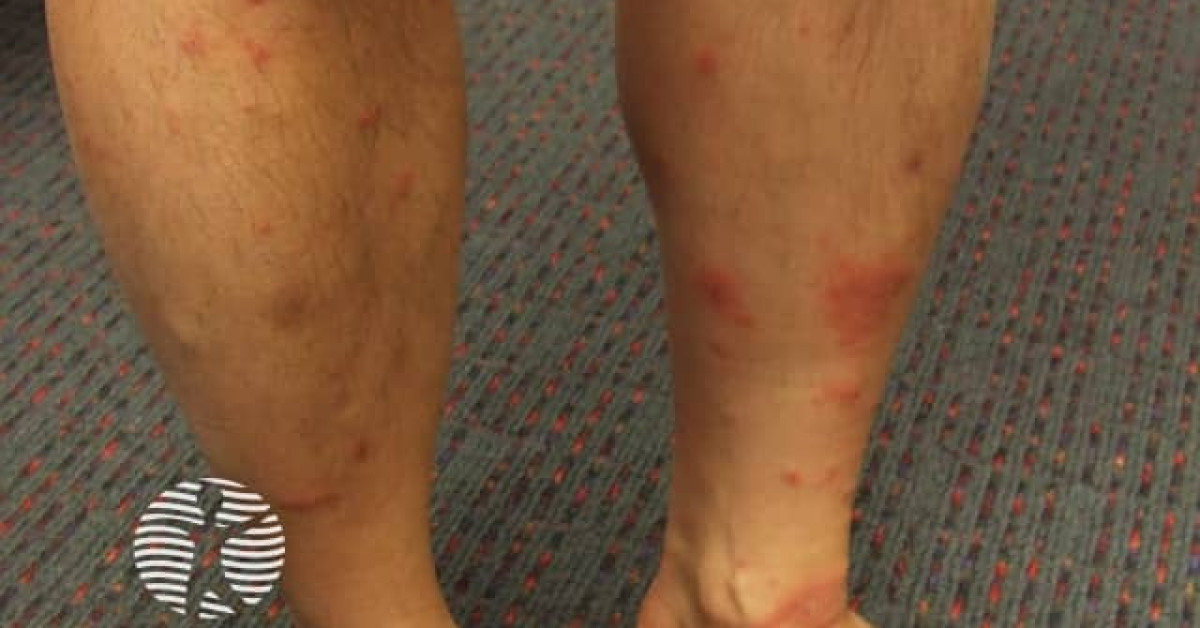 Contact allergic dermatitis of the arms and legs image