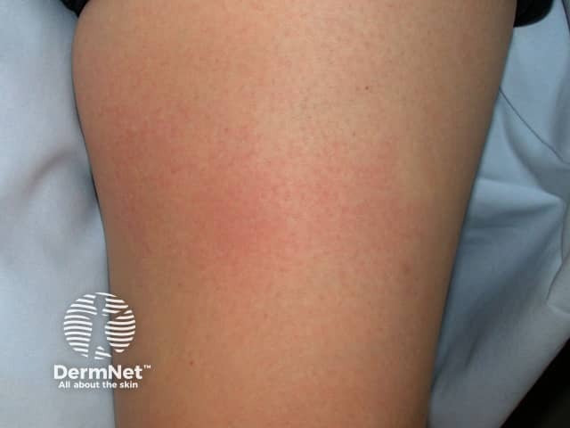 Contact allergic dermatitis of the arms and legs