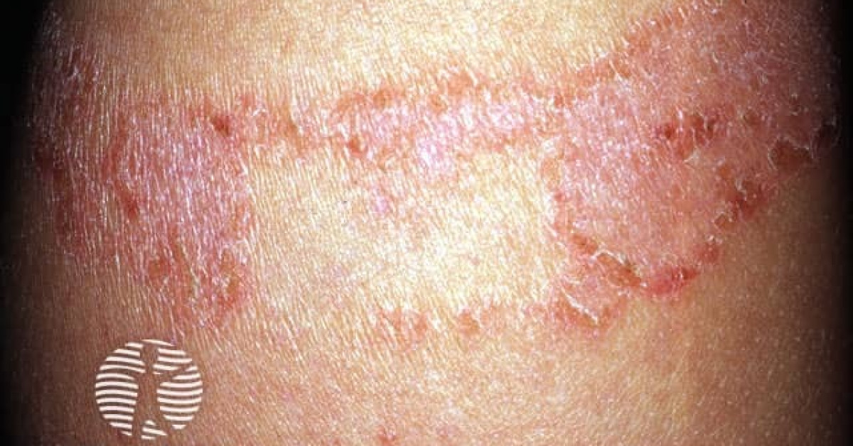 Plaster rash image