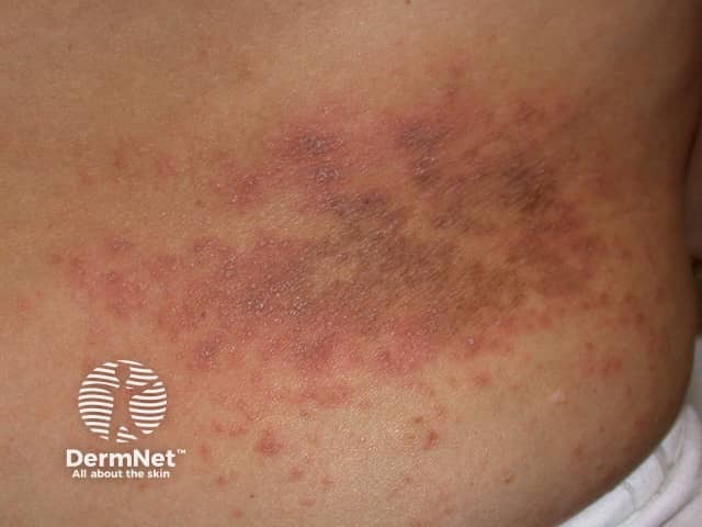 Contact allergic dermatitis of the torso