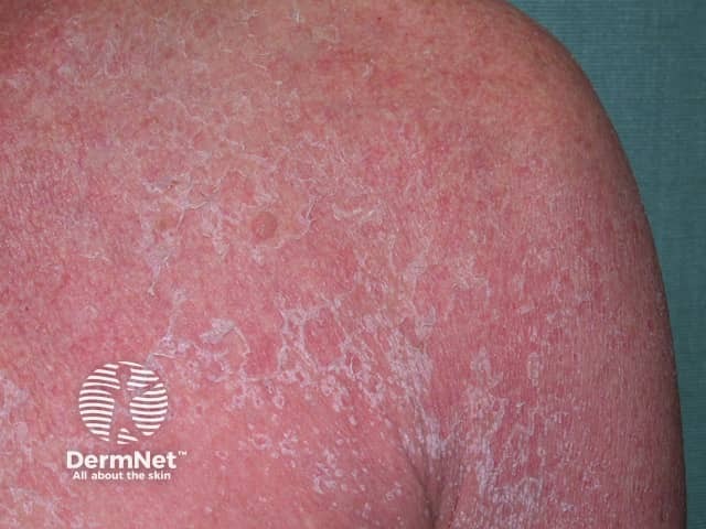 Contact allergic dermatitis of the torso