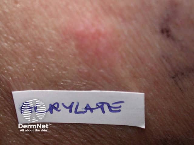 Allergic patch test due to acrylate