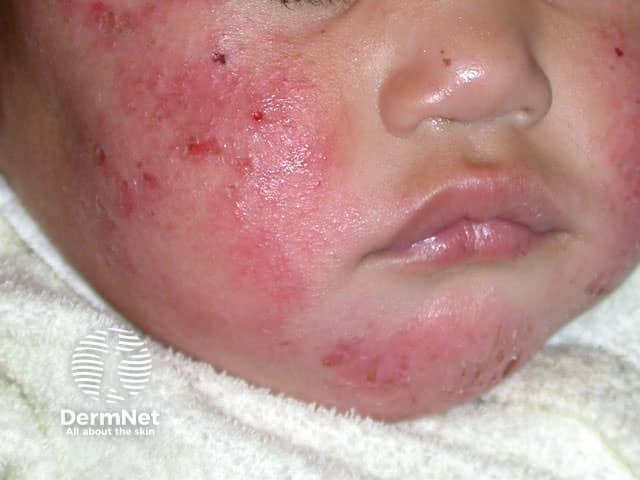 Infantile atopic dermatitis, face