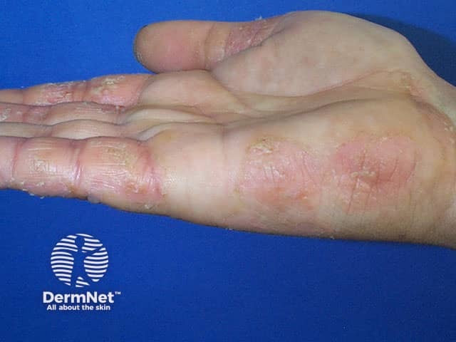 Atopic hand dermatitis involving the palmar aspect of the fingers and side of hand