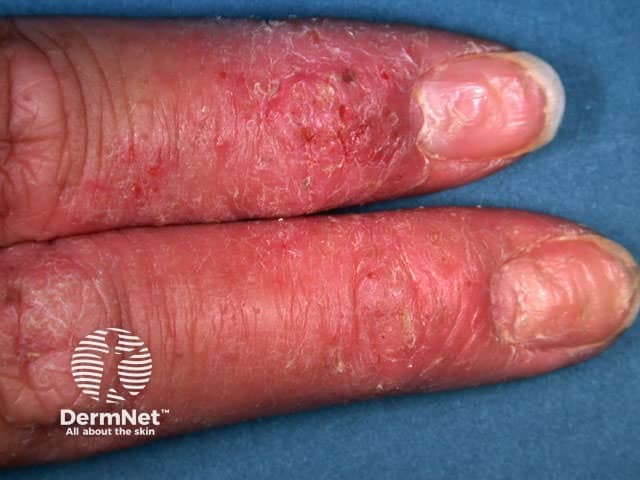 Transverse nail ridging with atopic dermatitis of the distal fingers