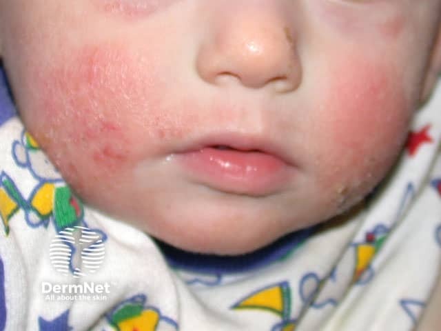Infantile atopic dermatitis on the cheeks